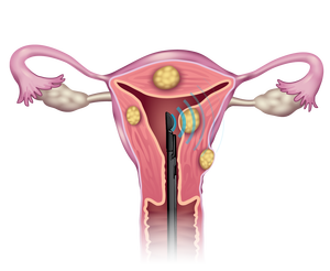 Uterine-Fibroids_04-02